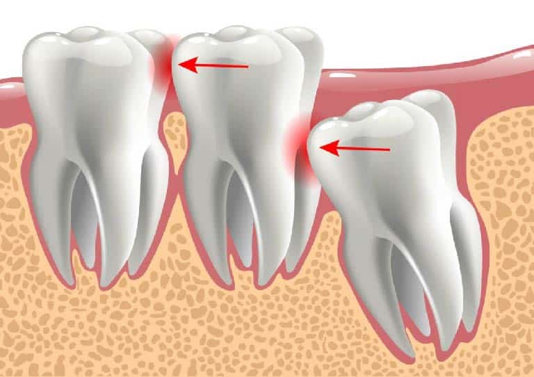 wisdom tooth coming in pain